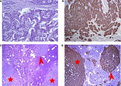 New Regions With Molecular Alterations in a Rare Case of Insulinomatosis: Case Report With Literature Review